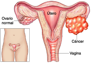 El cáncer de ovario