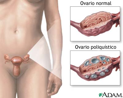 ¿Qué son los ovarios poliquísticos?