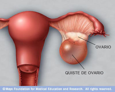 Todo lo que debes saber sobre el quiste de ovario