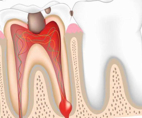 ¿Qué es la Pulpitis?